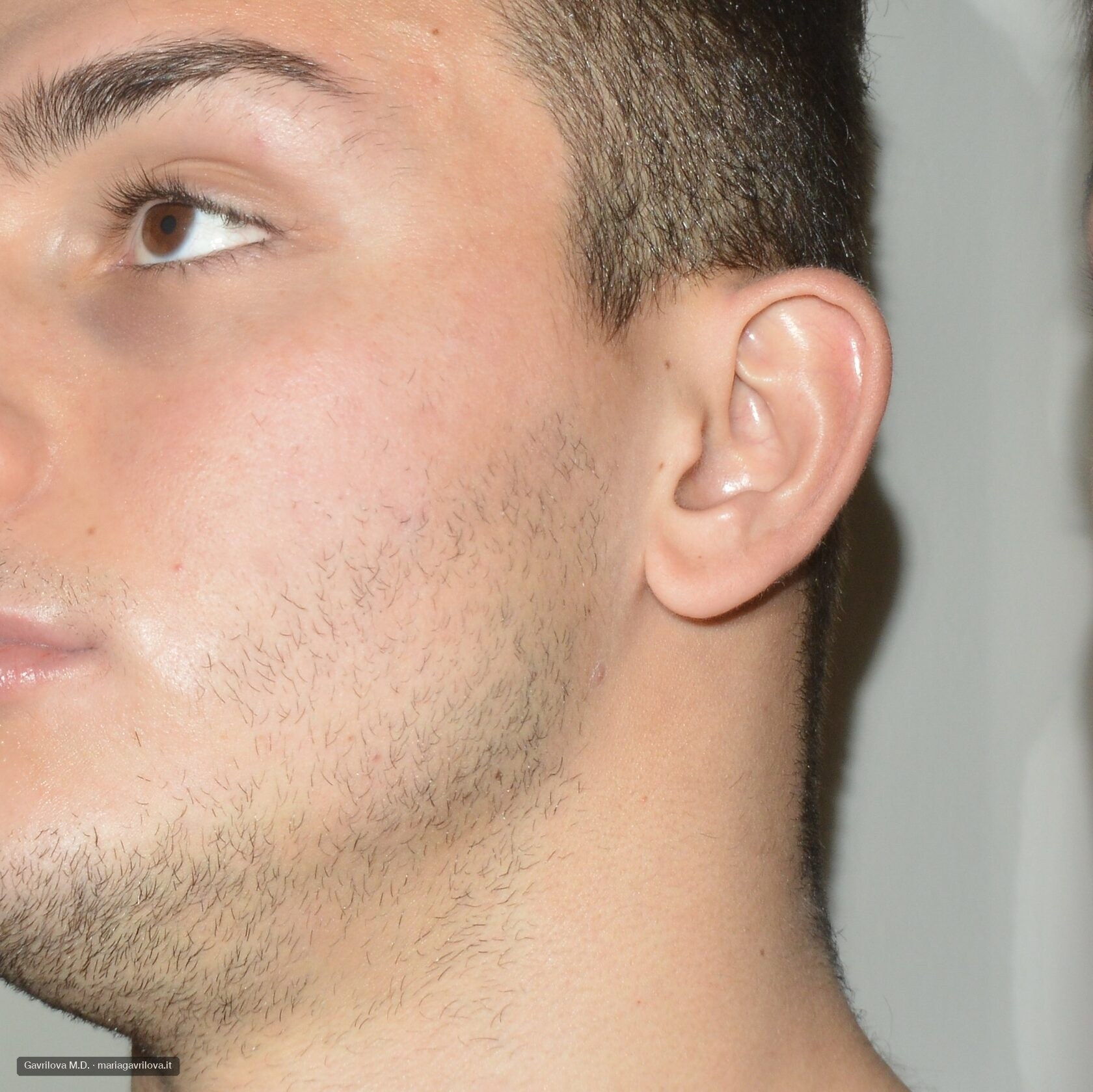 Acne, dopo il trattamento