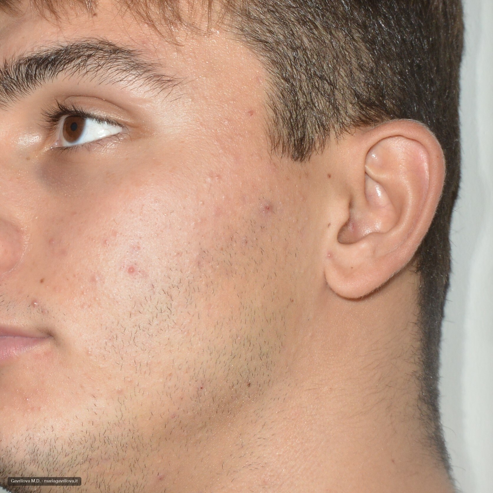 Acne, prima del trattamento
