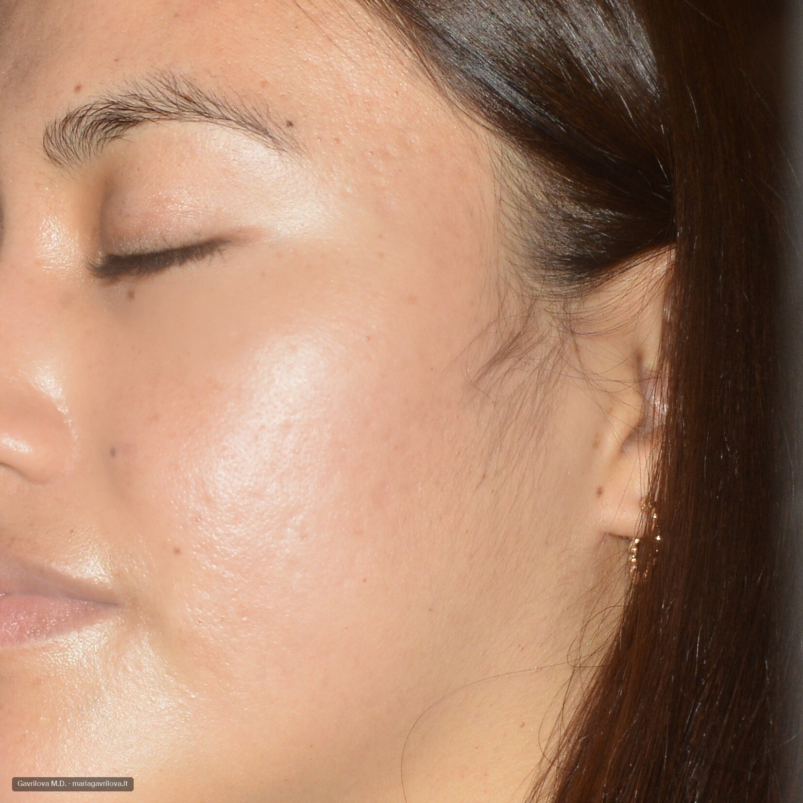 Acne, dopo il trattamento