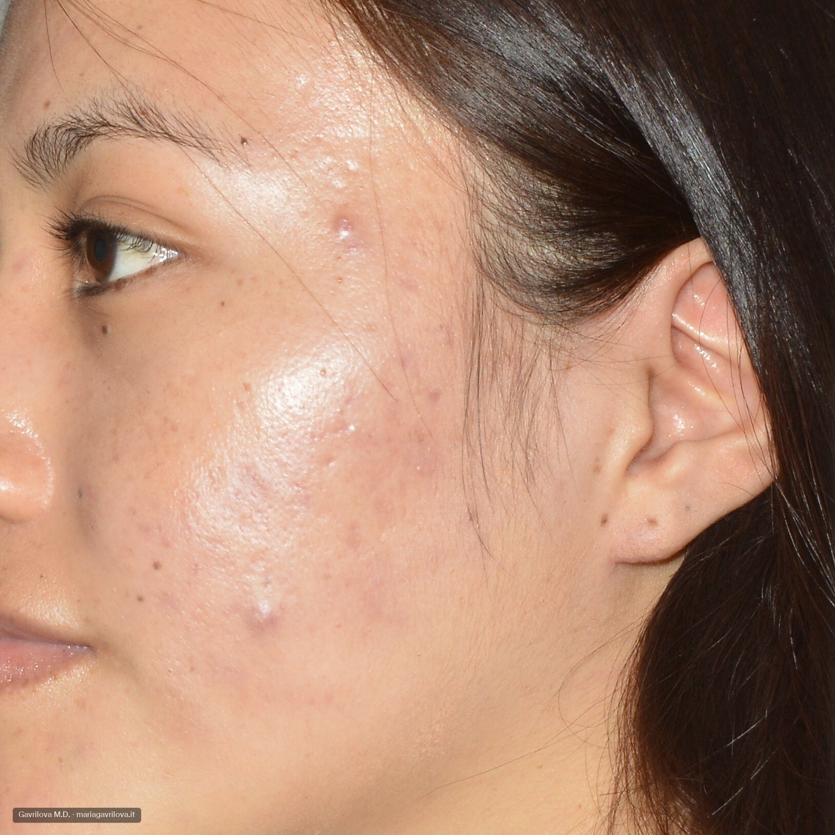 Acne, prima del trattamento