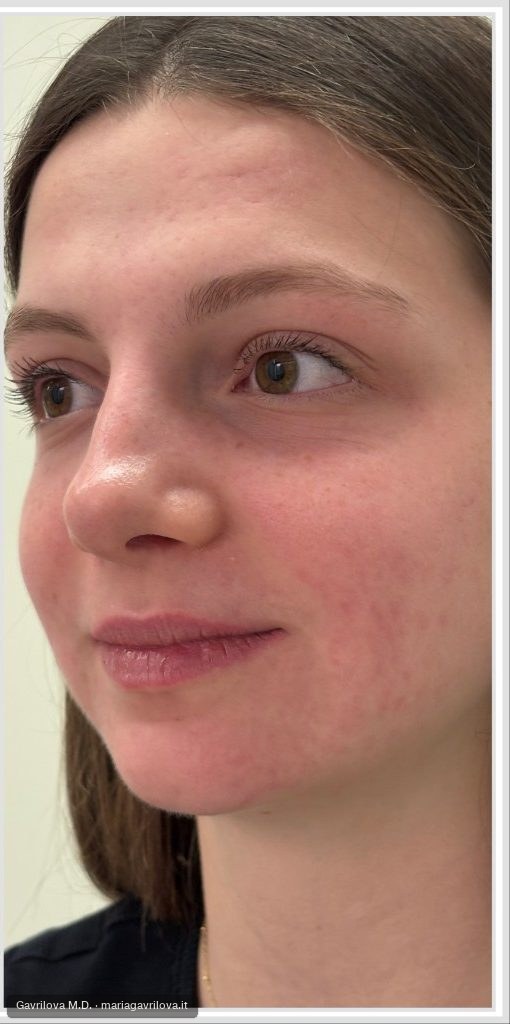 Acne, dopo il trattamento