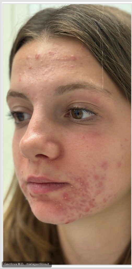 Acne, prima del trattamento
