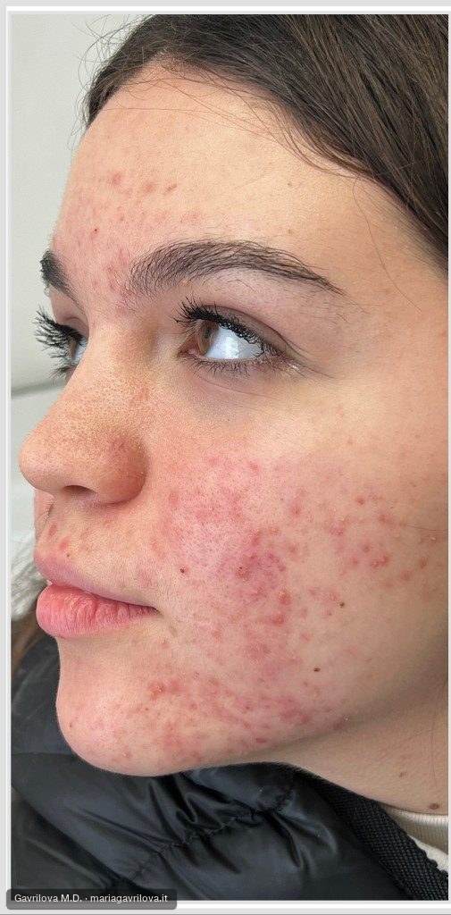 Acne, prima