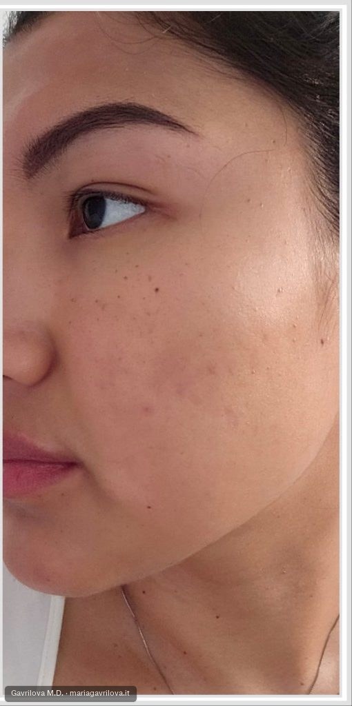 Acne, dopo il trattamento
