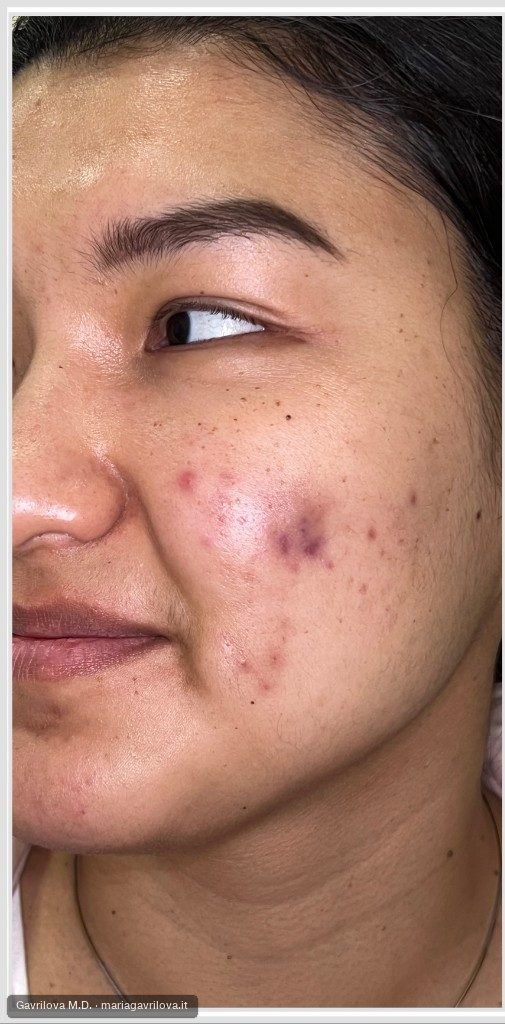 Acne, prima del trattamento