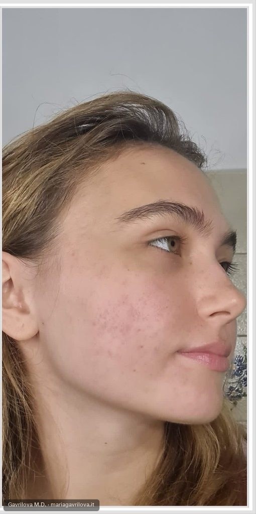 Acne, dopo il trattamento