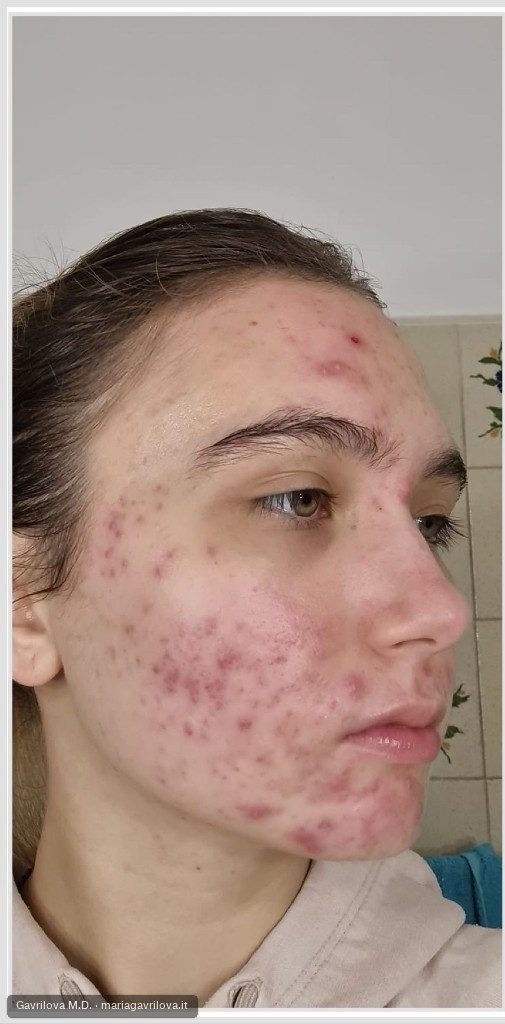Acne, prima del trattamento