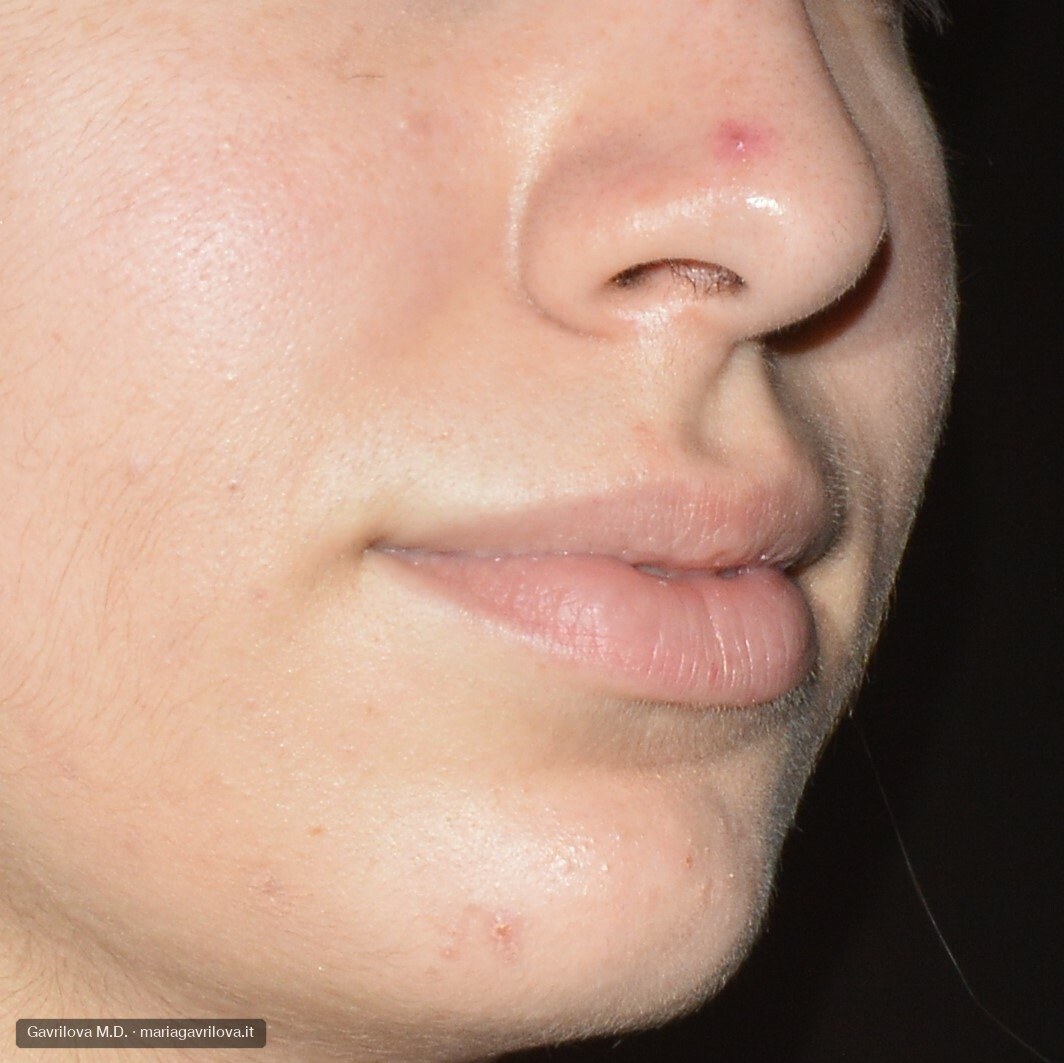 Angioma stellato sul naso, prima