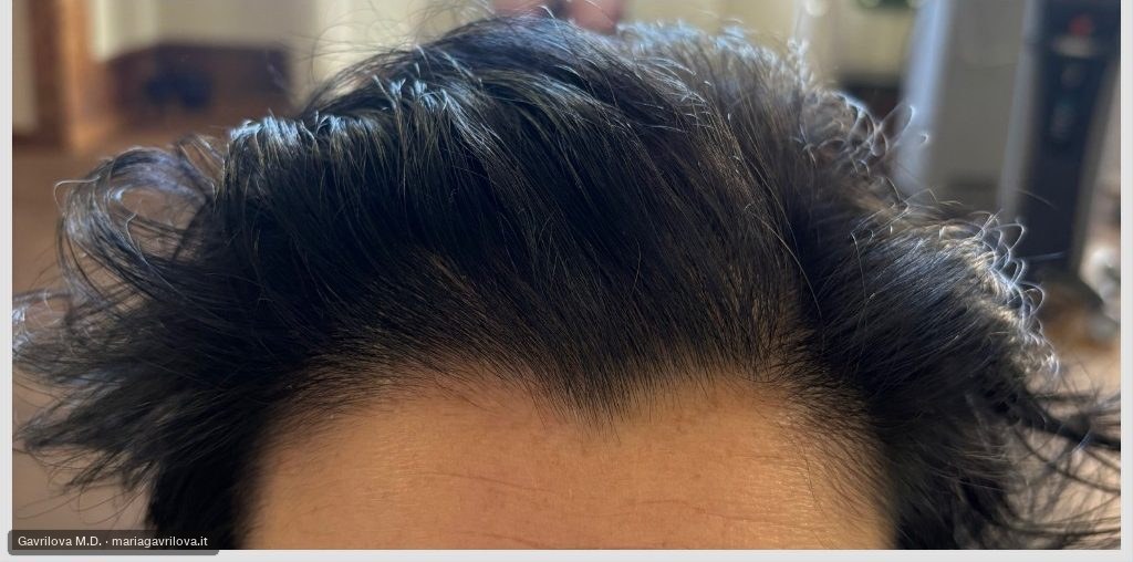Capelli, dopo il trattamento