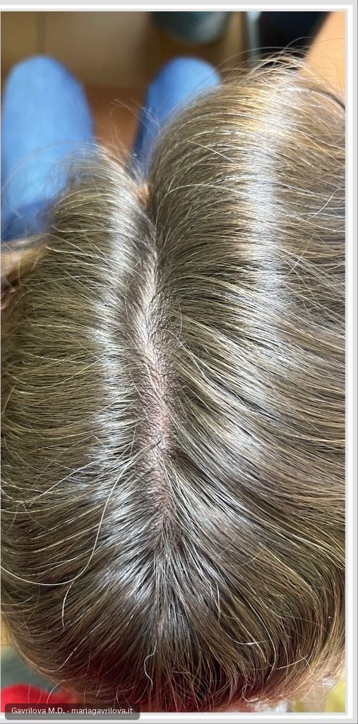 Capelli, dopo